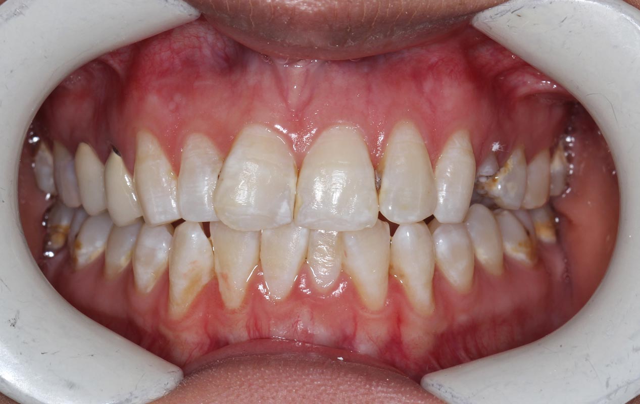 Full Arch/Full Mouth Implant Bridges Before