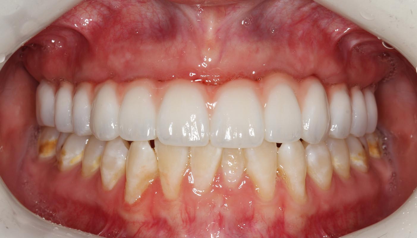 Full Arch/Full Mouth Implant Bridges After