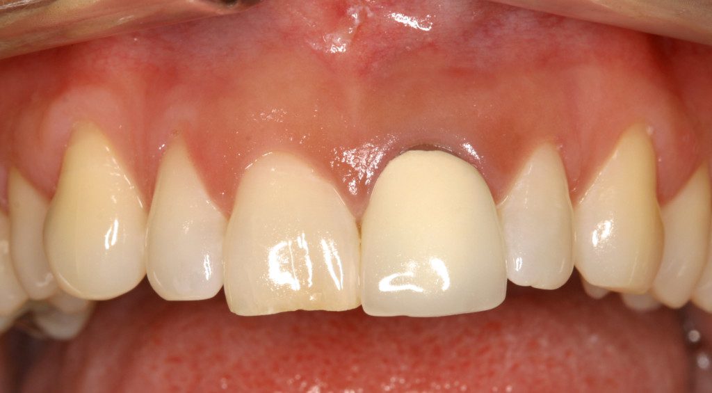 Crowns That Don't Match - Dental Implant Center Crowns That Don't Match - Dental Implant Center