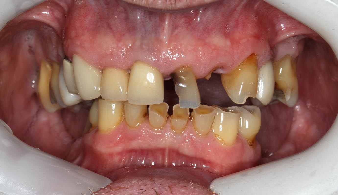 Full Arch/Full Mouth Implant Bridges Before