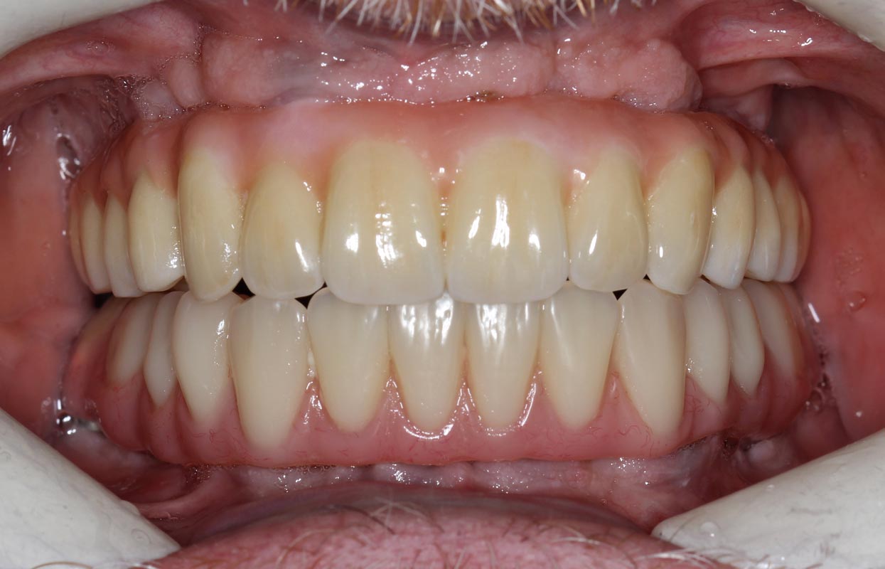 Full Arch/Full Mouth Implant Bridges After