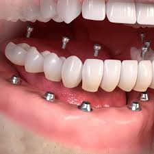 “Procedures done by prosthodontists, full mouth tooth replacement"