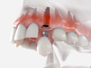 Single Implant and crown