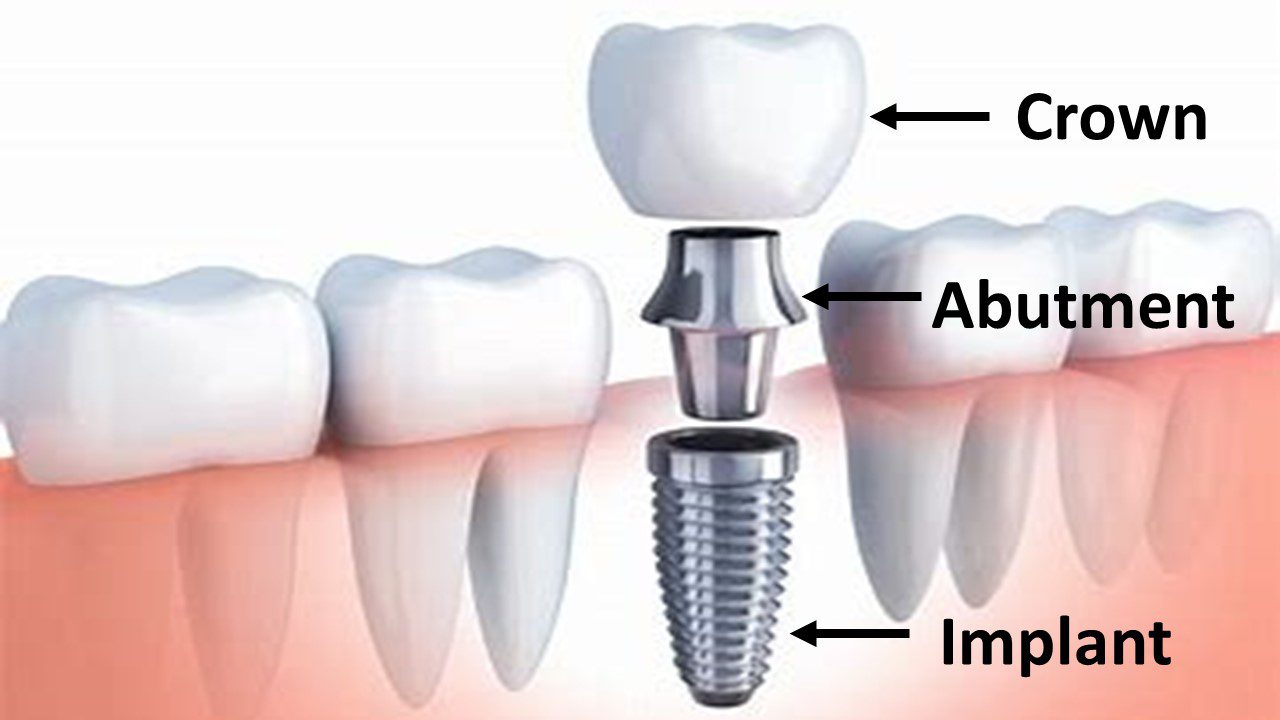 Crown/Bridge Dental Implant