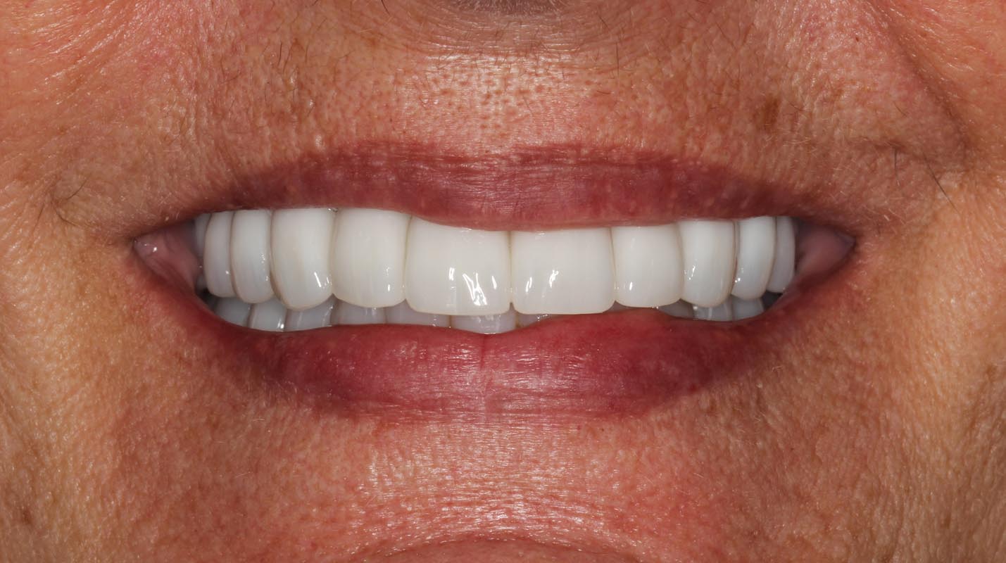 Full Arch/Full Mouth Implant Bridges After