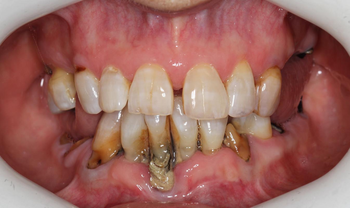 Full Arch/Full Mouth Implant Bridges Before