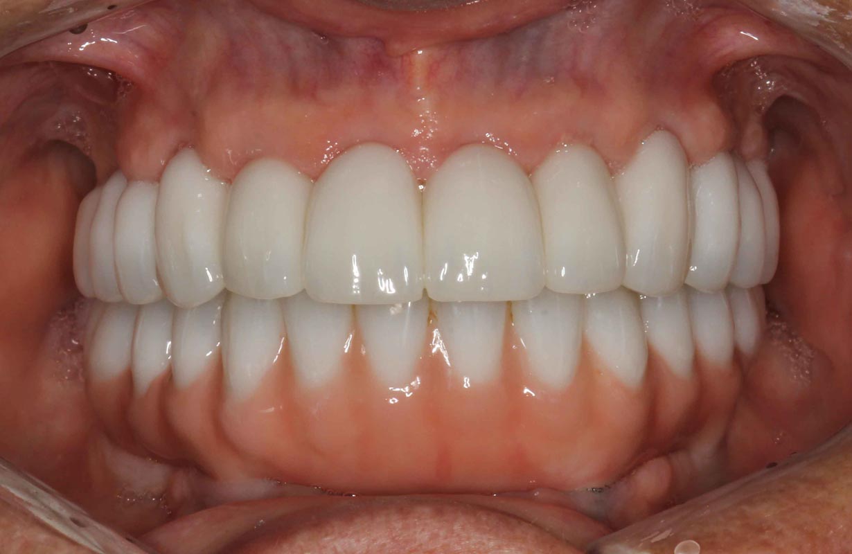 Full Arch/Full Mouth Implant Bridges After