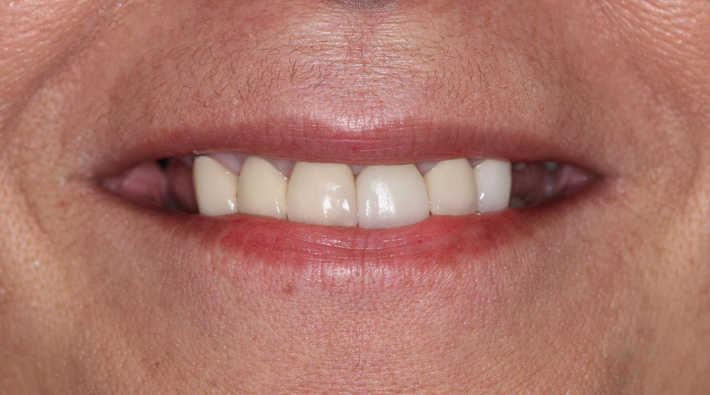 Full Arch/Full Mouth Implant Bridges Before