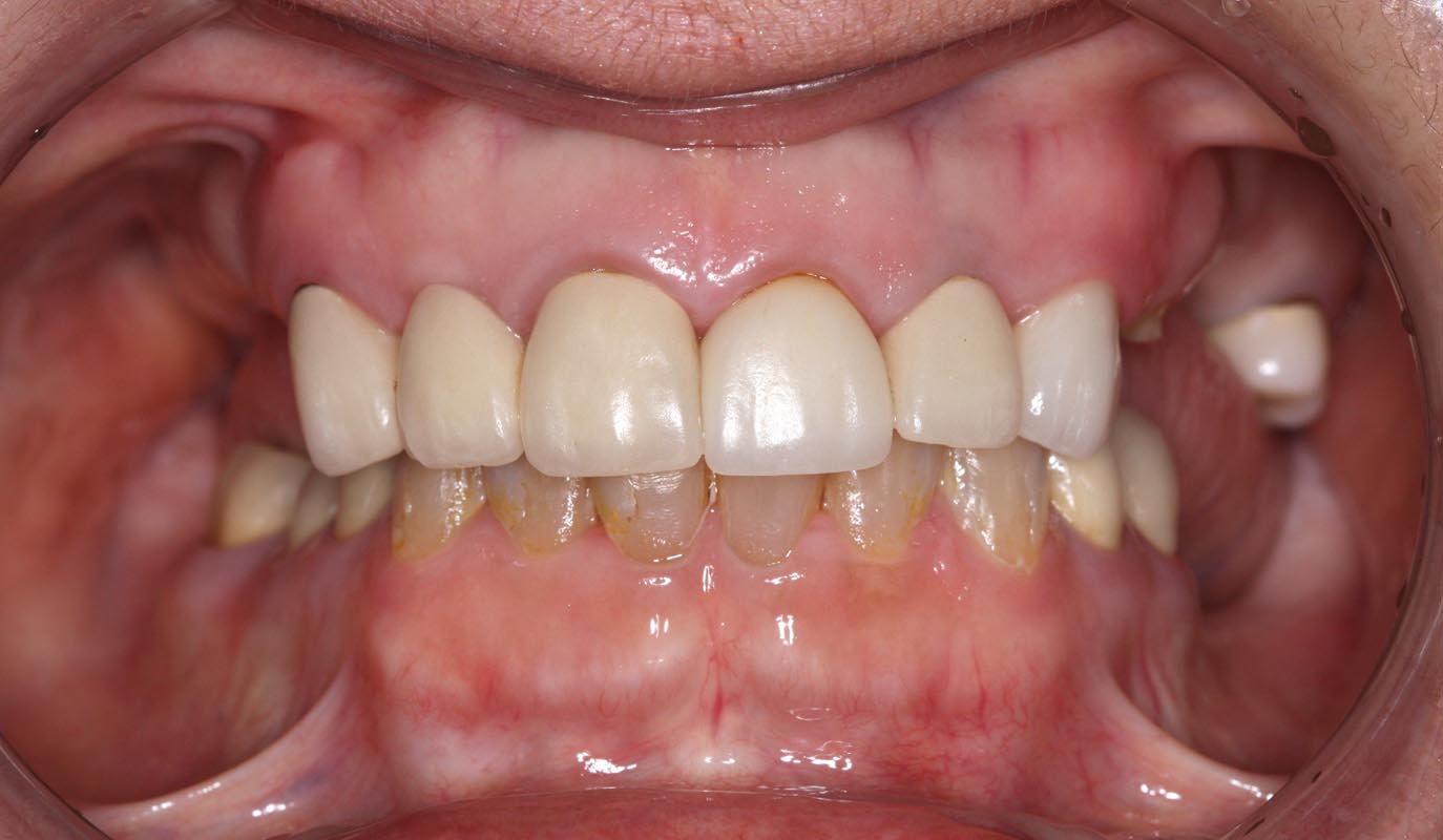 Full Arch/Full Mouth Implant Bridges Before