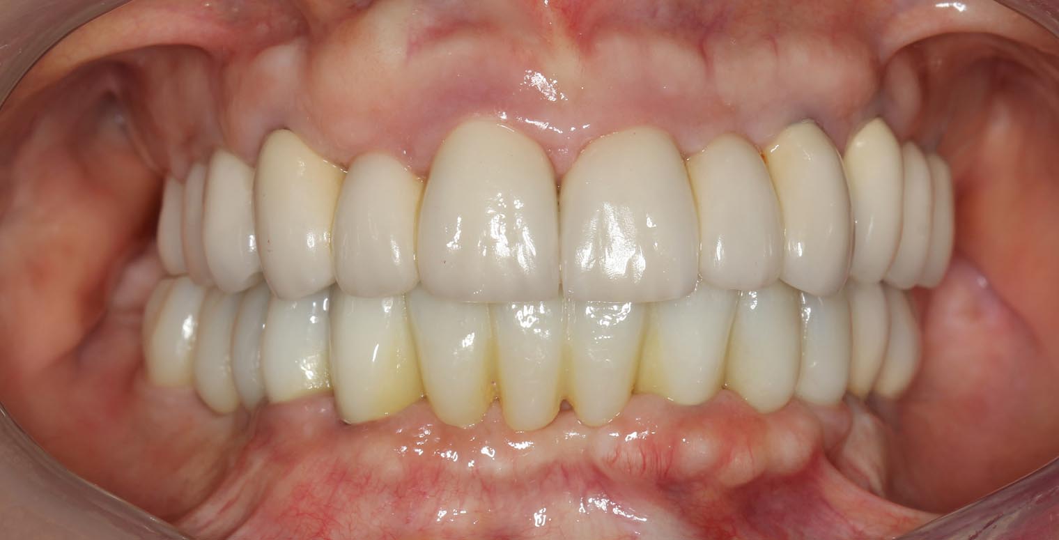 Full Arch/Full Mouth Implant Bridges After