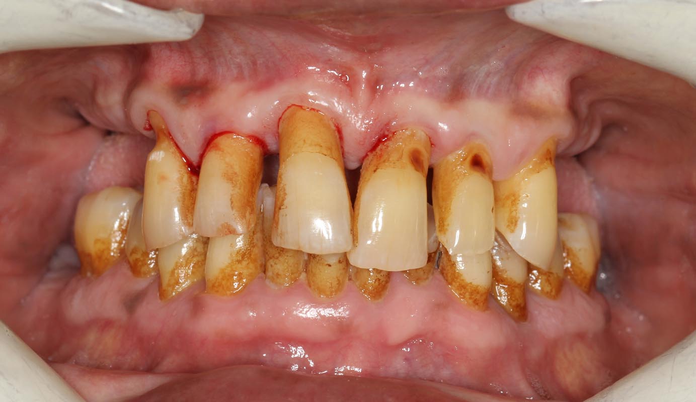 Full Arch/Full Mouth Implant Bridges Before