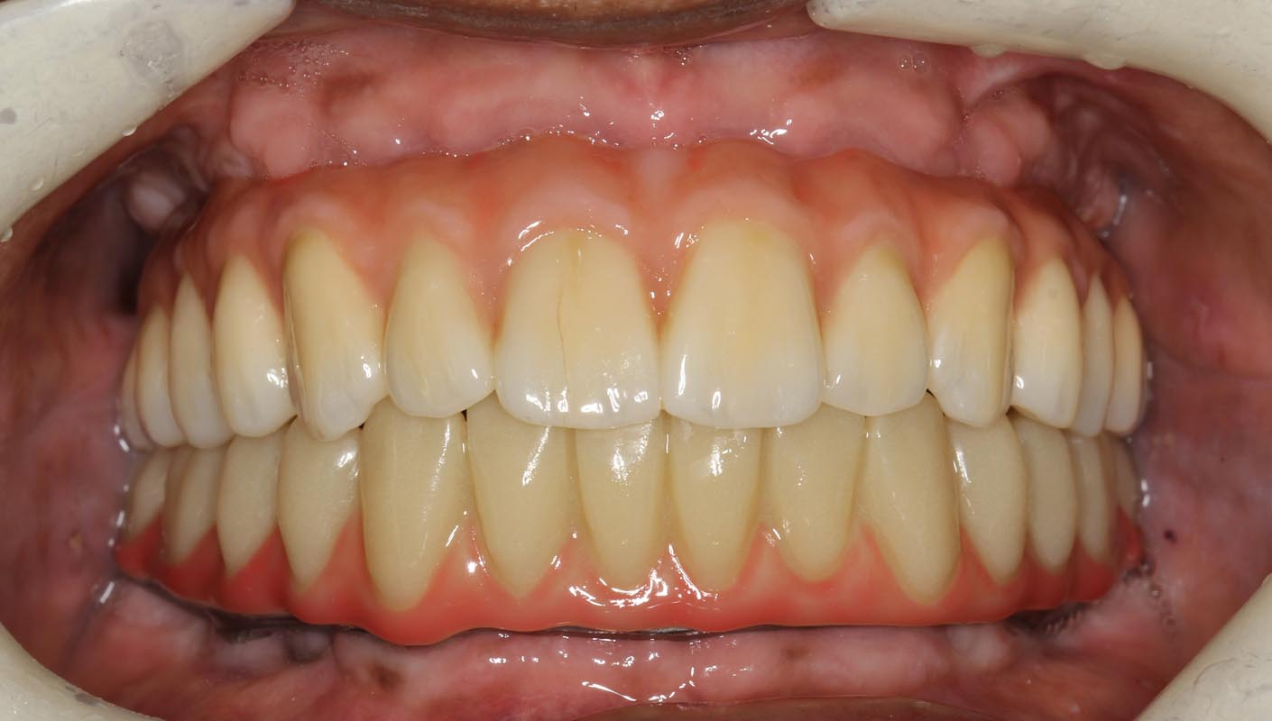 Full Arch/Full Mouth Implant Bridges After