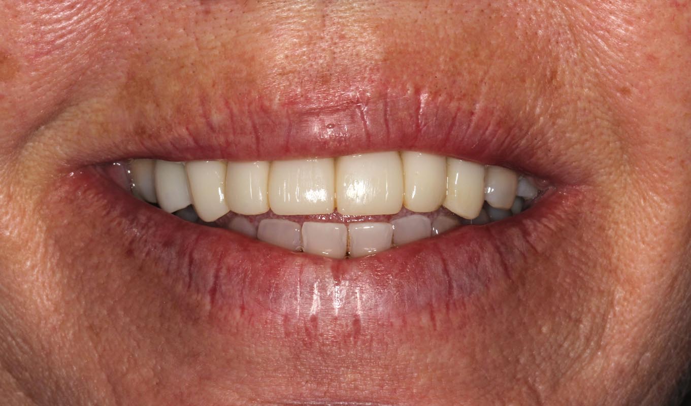 Full Arch/Full Mouth Implant Bridges Before