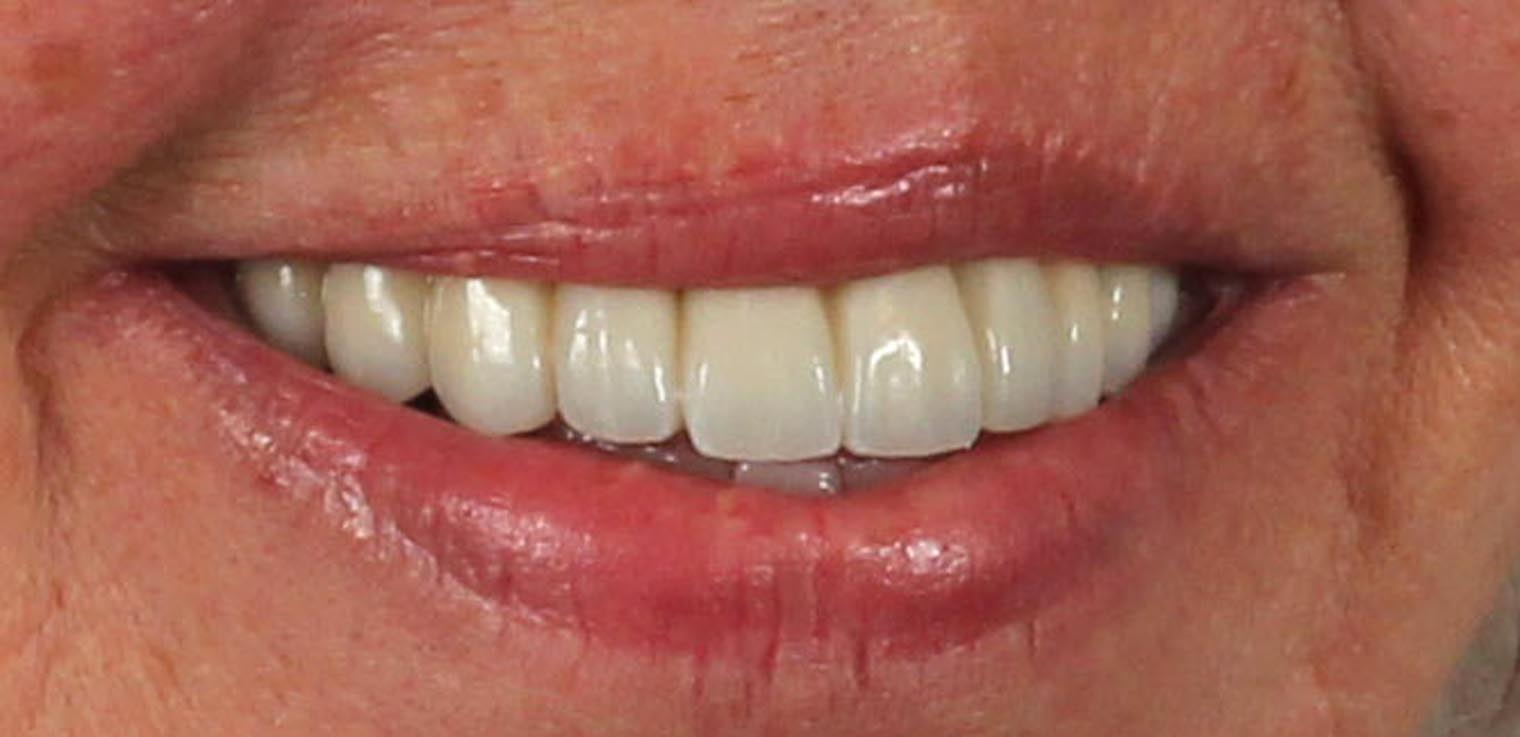 Full Arch/Full Mouth Implant Bridges After