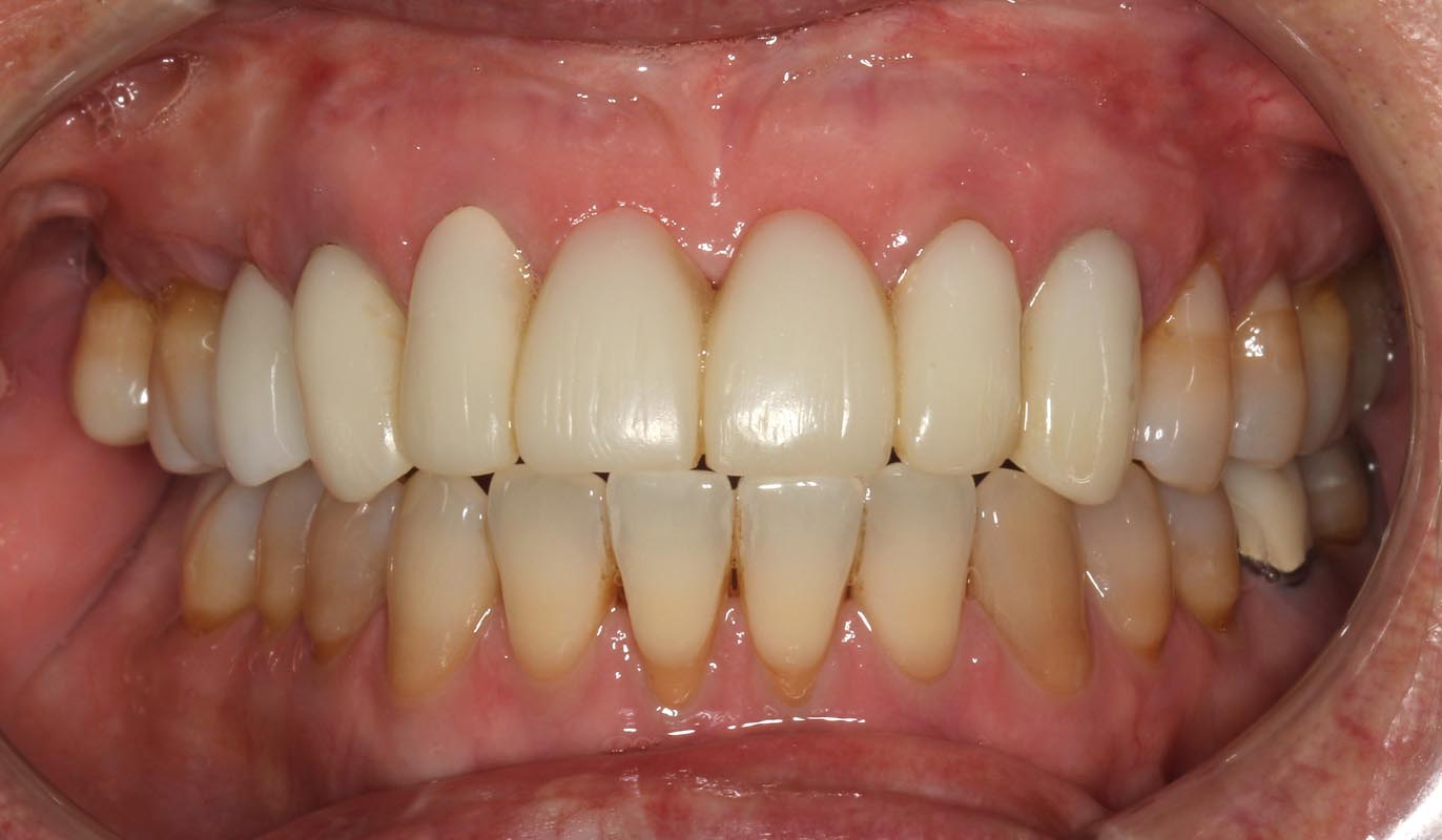 Full Arch/Full Mouth Implant Bridges Before