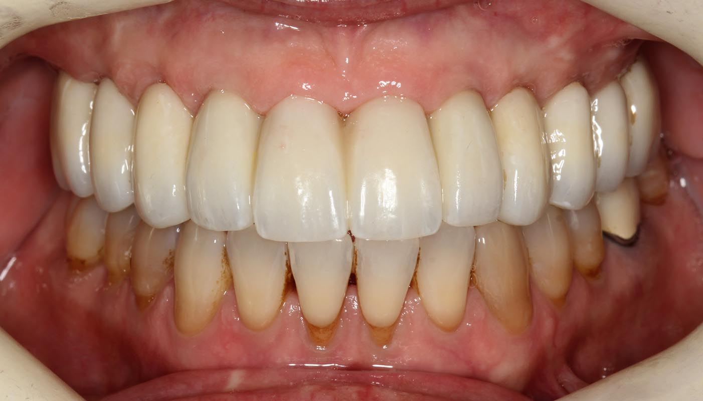 Full Arch/Full Mouth Implant Bridges After