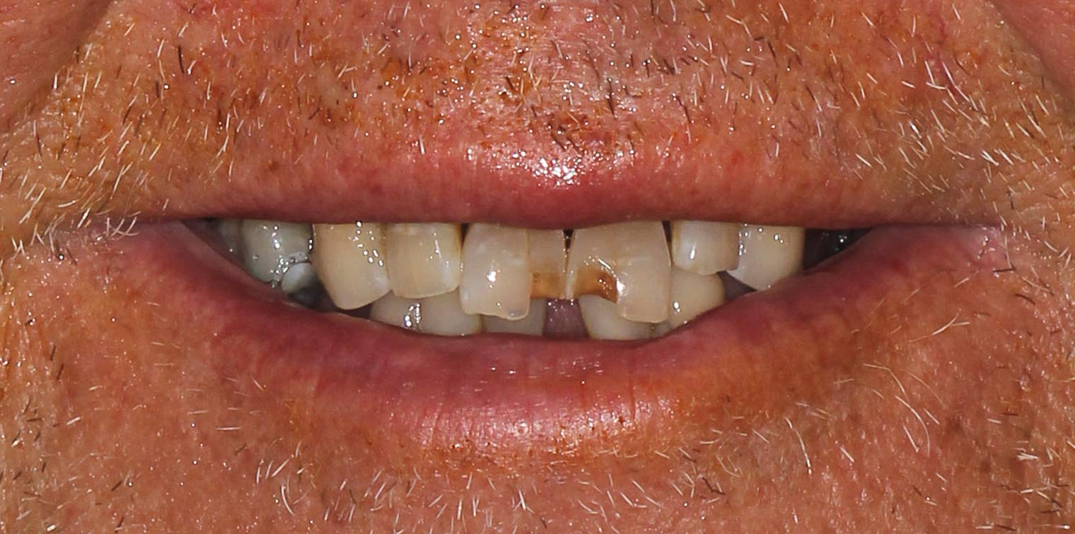 Full Arch/Full Mouth Implant Bridges Before