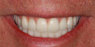 Full Arch/Full Mouth Implant Bridges After