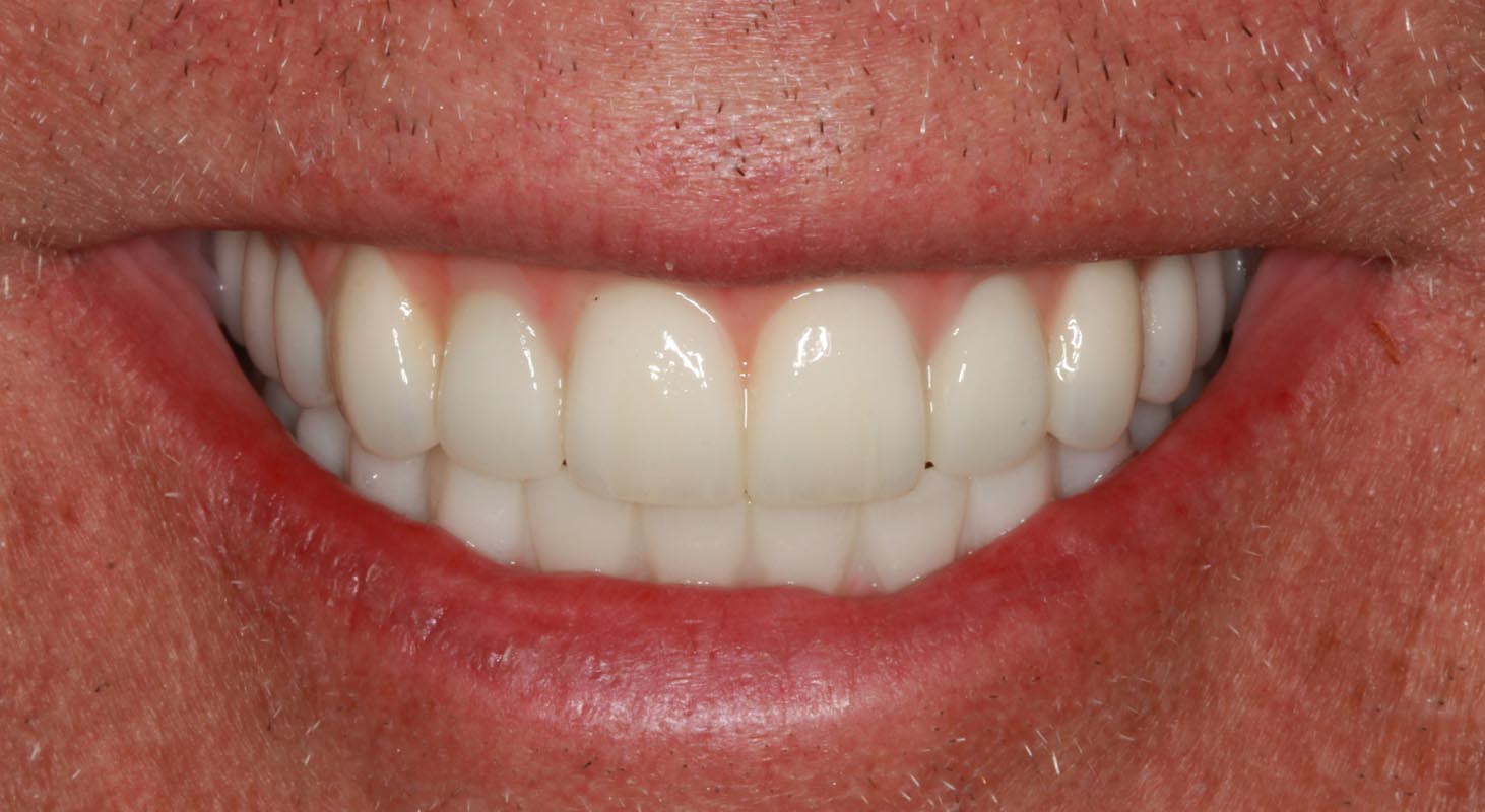 Full Arch/Full Mouth Implant Bridges After