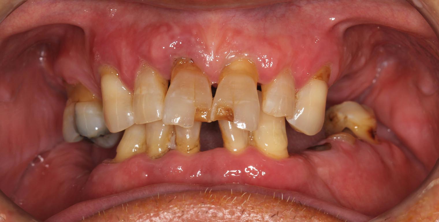 Full Arch/Full Mouth Implant Bridges Before