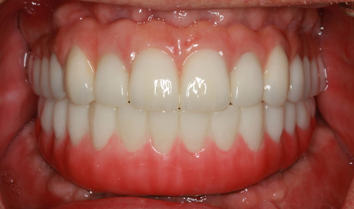 Full Arch/Full Mouth Implant Bridges After