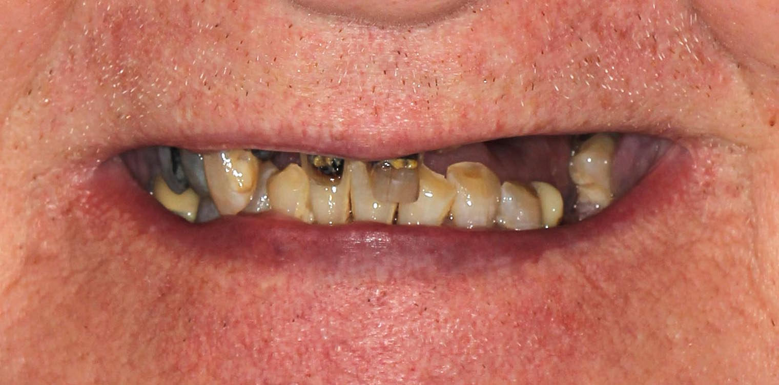 Full Arch/Full Mouth Implant Bridges Before