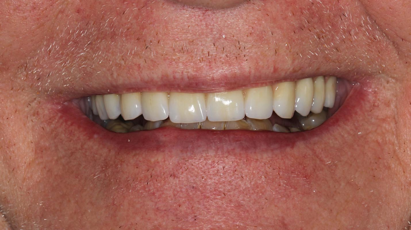 Full Arch/Full Mouth Implant Bridges After