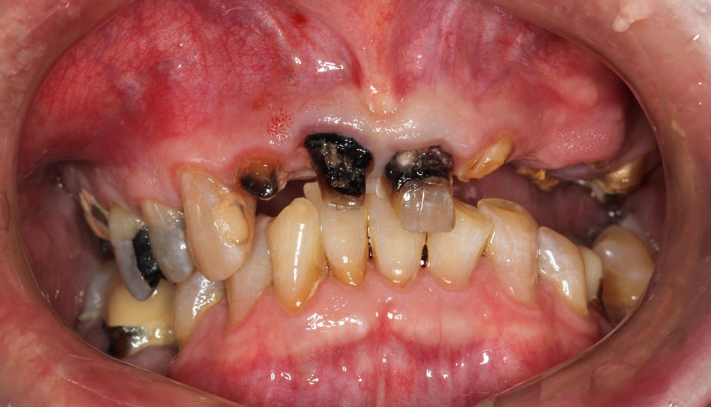 Full Arch/Full Mouth Implant Bridges Before