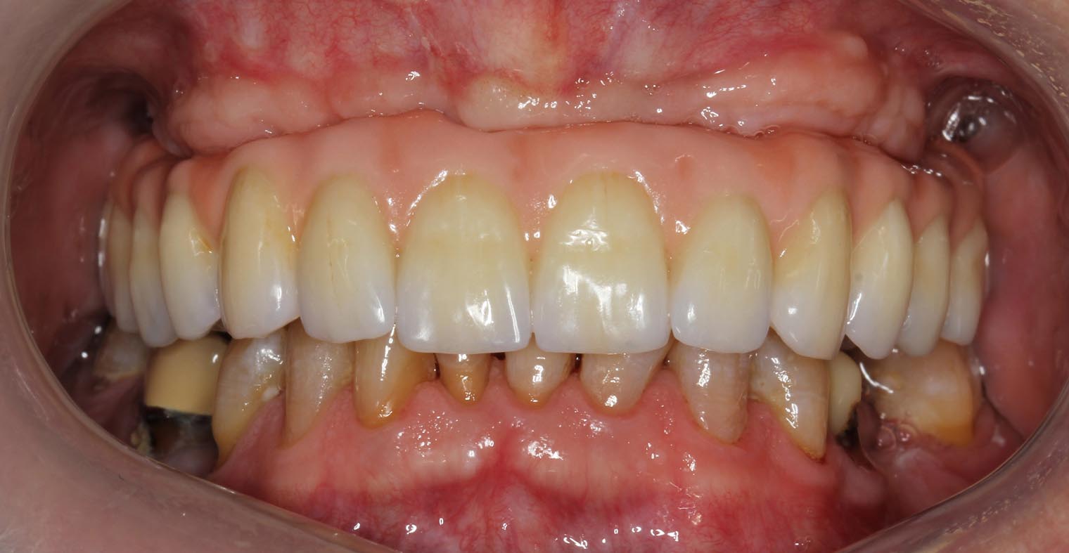 Full Arch/Full Mouth Implant Bridges After