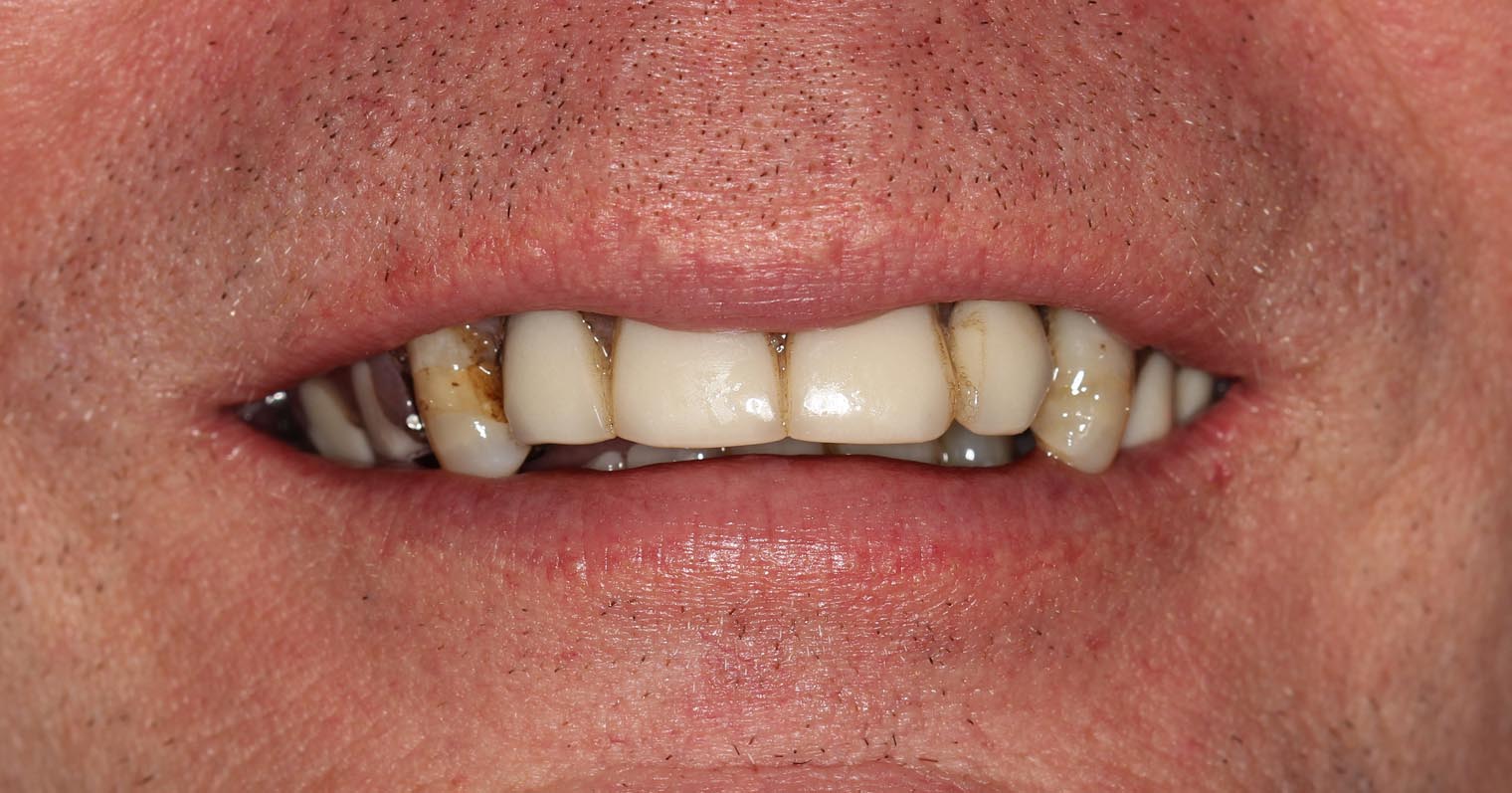 Full Arch/Full Mouth Implant Bridges Before