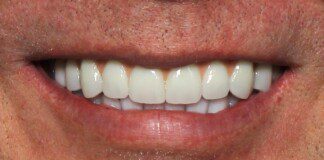 Full Arch/Full Mouth Implant Bridges After