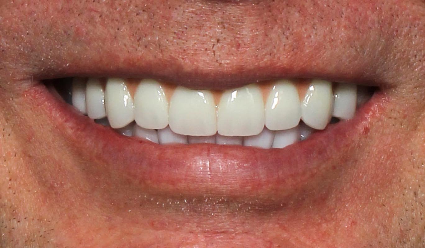 Full Arch/Full Mouth Implant Bridges After