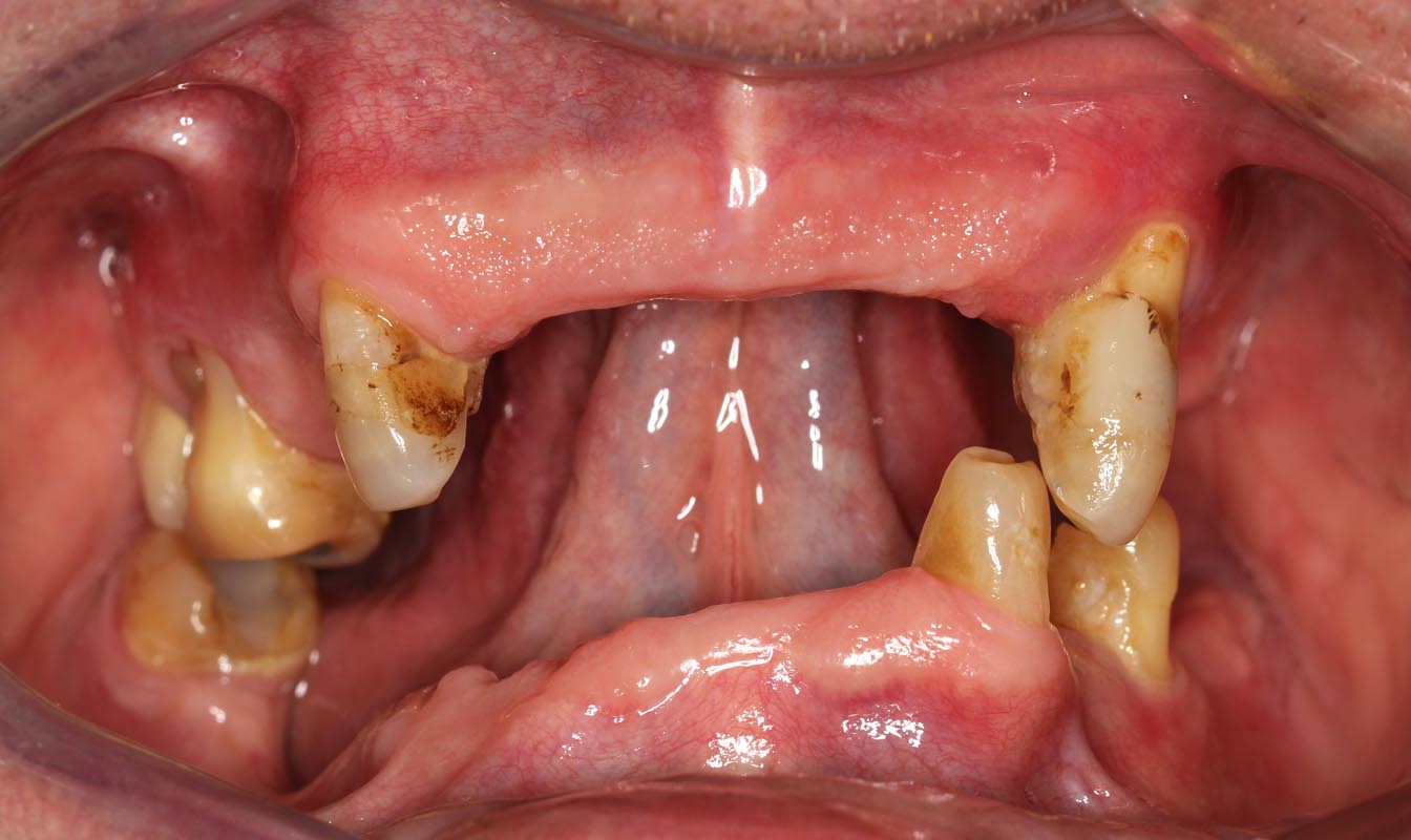 Full Arch/Full Mouth Implant Bridges Before