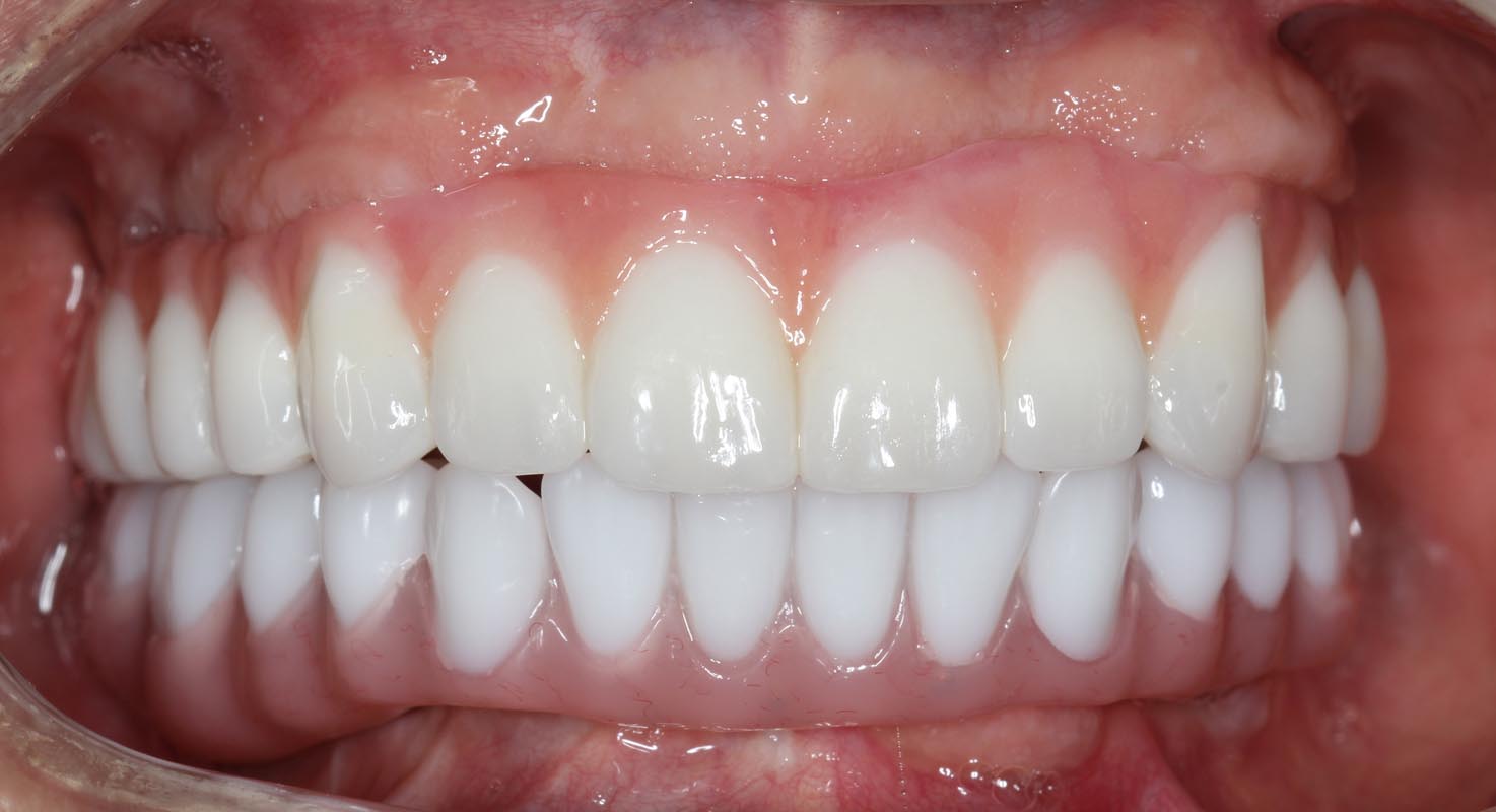 Full Arch/Full Mouth Implant Bridges After