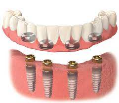 Lower denture has metal housings built into the underside of the denture with nylon inserts that snap onto and into the abutment on the implant to secure the prosthesis.