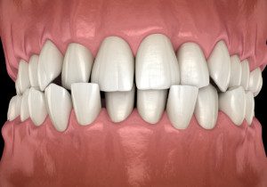 "Top causes of tooth breakage, imbalanced bite"