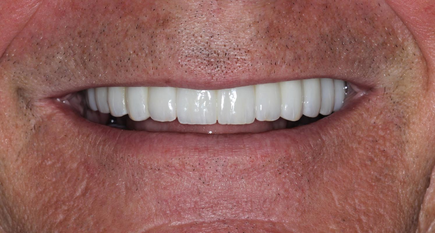 Full Arch/Full Mouth Implant Bridges After