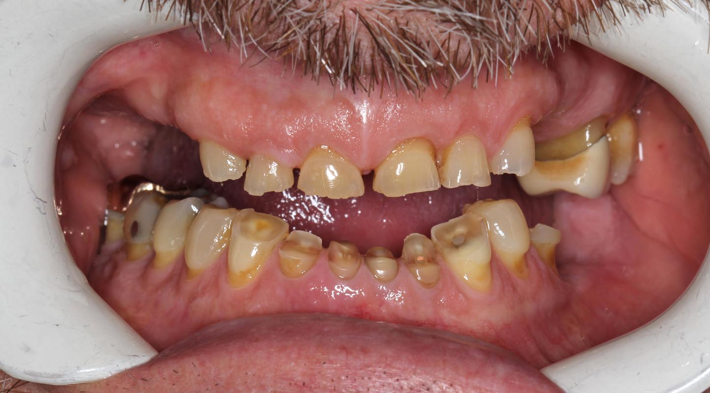 Full Arch/Full Mouth Implant Bridges Before