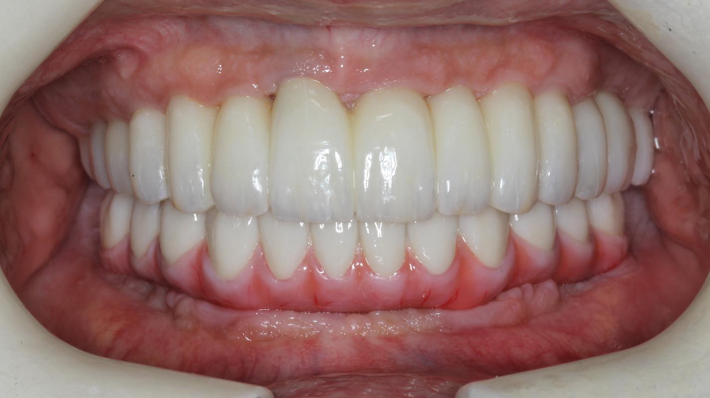 Full Arch/Full Mouth Implant Bridges After