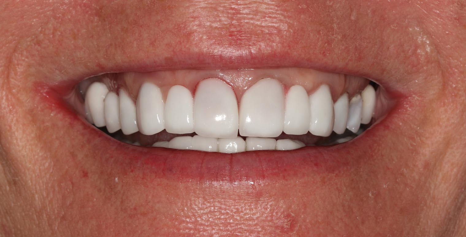 Full Arch/Full Mouth Implant Bridges Before