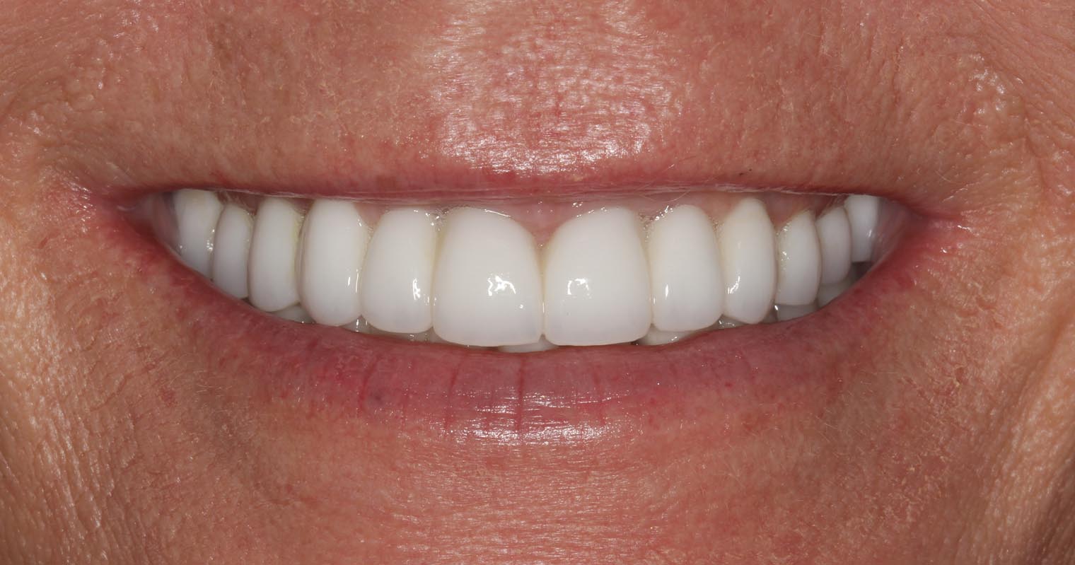 Full Arch/Full Mouth Implant Bridges After