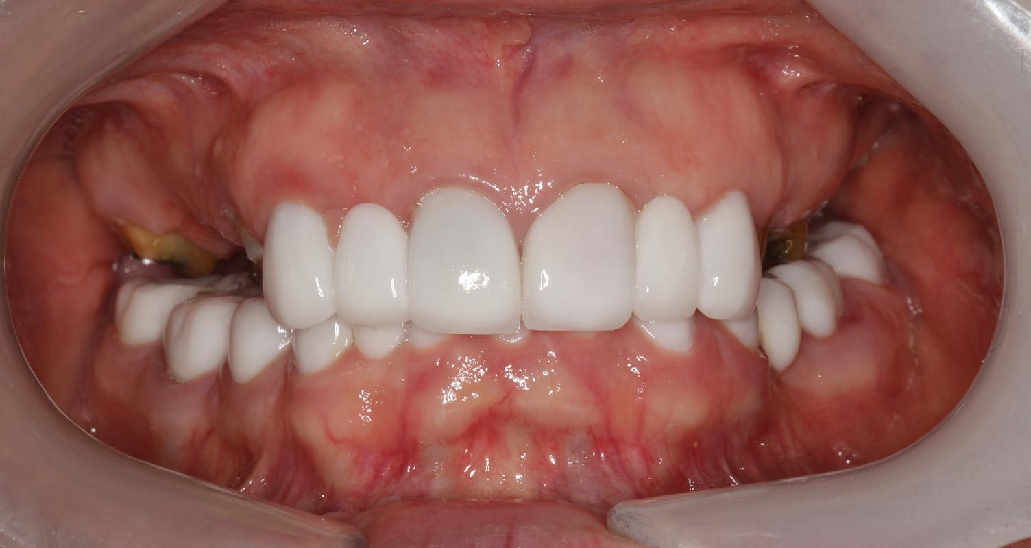 Full Arch/Full Mouth Implant Bridges Before