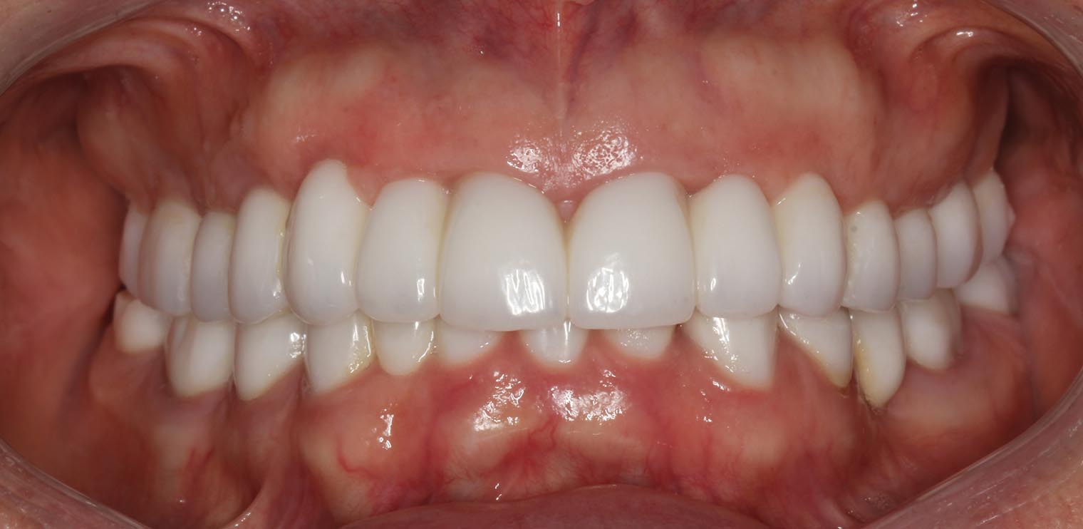 Full Arch/Full Mouth Implant Bridges After