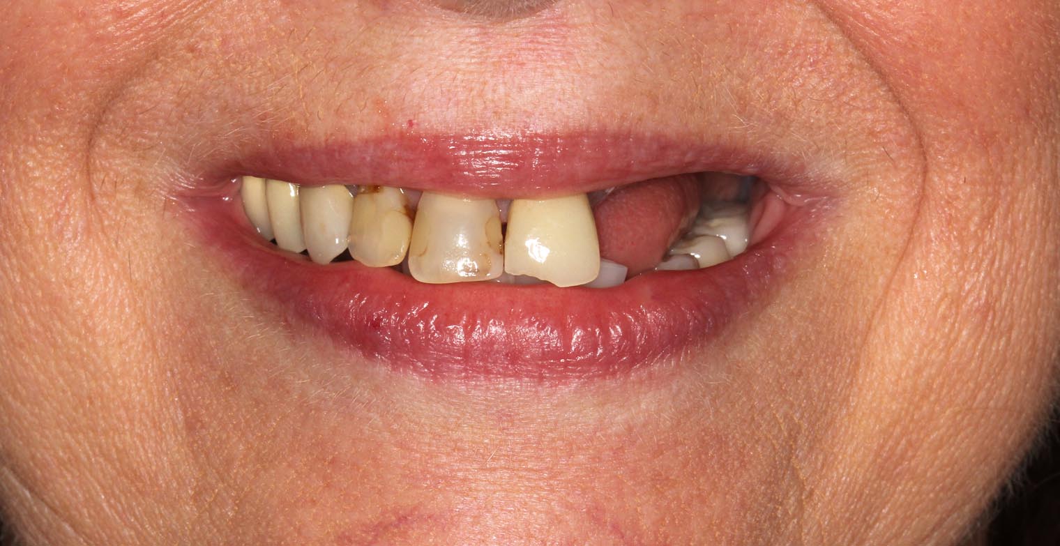 Full Arch/Full Mouth Implant Bridges Before