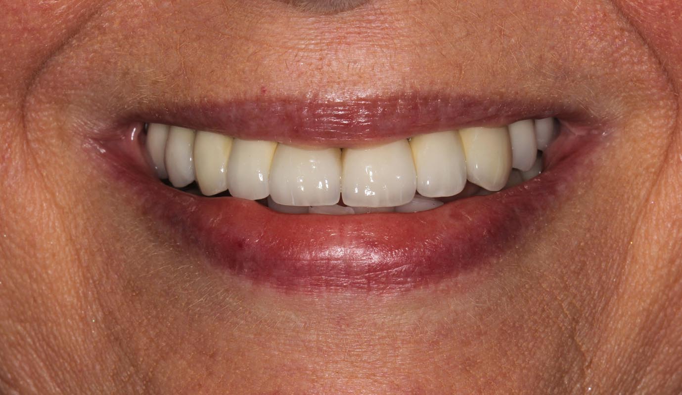 Full Arch/Full Mouth Implant Bridges After