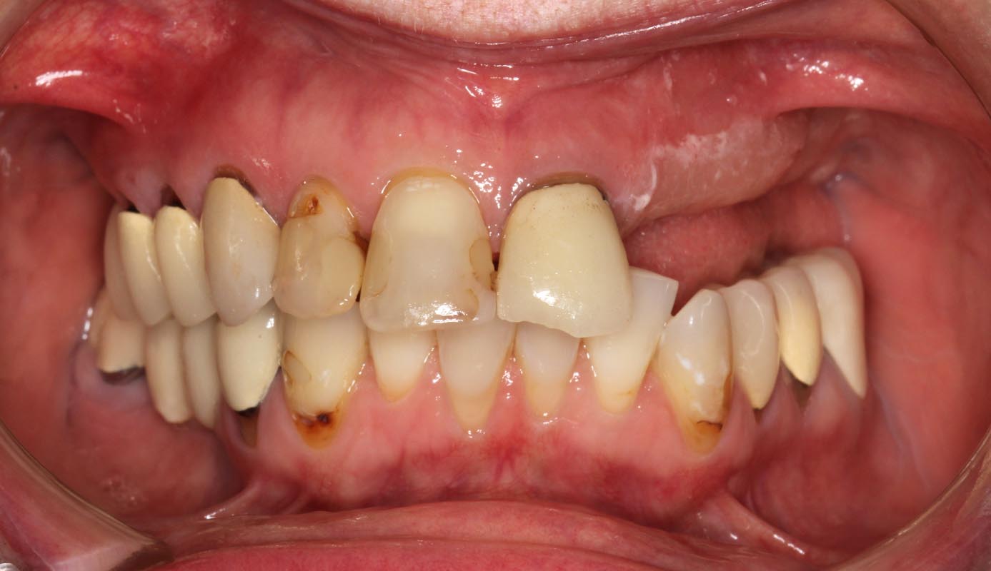 Full Arch/Full Mouth Implant Bridges Before