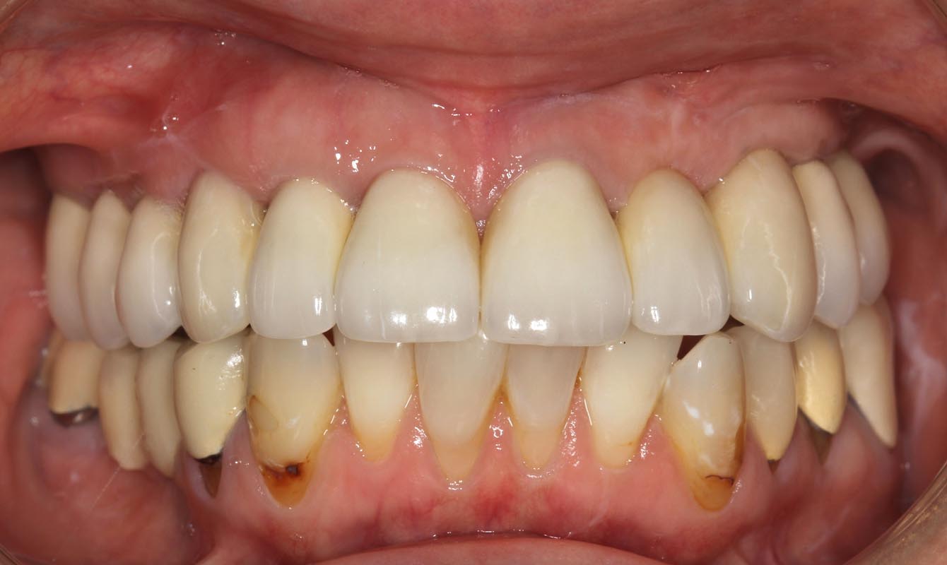 Full Arch/Full Mouth Implant Bridges After