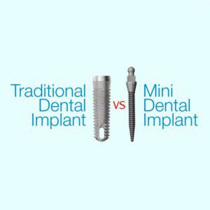 A comparison of traditional implants and mini implants