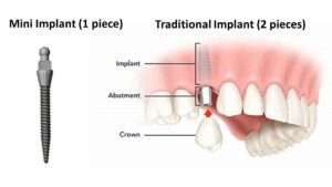 Comparison of mini implant (1 piece) vs Traditional implant (2 pieces)