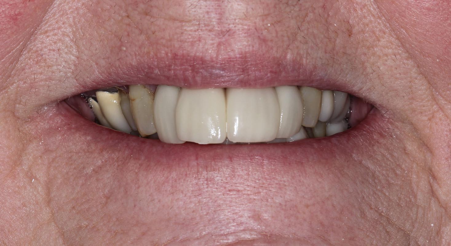 Full Arch/Full Mouth Implant Bridges Before